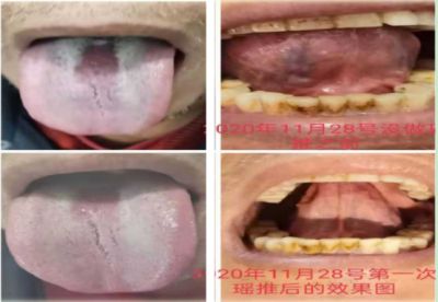 2024新春献礼专题报道 著名瑶医银疗推拿专家——周继辉