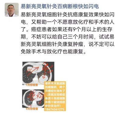 易新亮灵氧细胞针灸：开创百病断根快如闪电的创新疗法深度剖析！