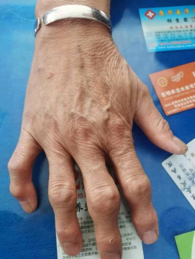 云南一中医独创“风湿骨病新诊疗法”:其“五大绝招”已治愈五千余患者