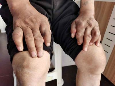 云南一中医独创“风湿骨病新诊疗法”:其“五大绝招”已治愈五千余患者