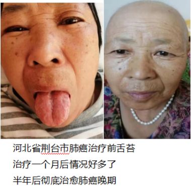 专攻多种恶性肿瘤及一切疑难绝症50年的大国名医——熊伟