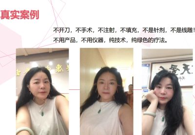 中医针灸浅筋膜非遗传承人——邓国珍 一针丰胸，一针治疗人体九成以上的疾病！